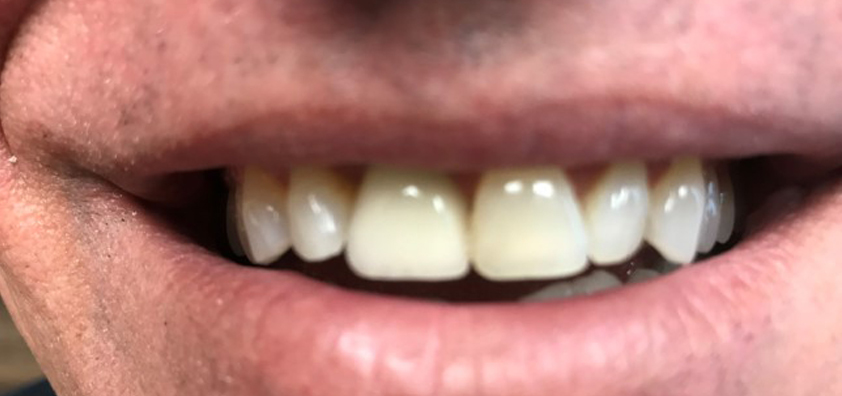 before and after dental implants Saddle Brook, NJ